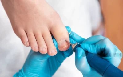 Comprehensive Guide to Ingrown Toenail Treatment: When to Seek Professional Help