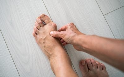 Bunions: Causes, Prevention, and When to Seek Help